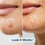 پچ درمان جوش کوزارکس_COSRX Acne Pimple Master Patch - Image 2